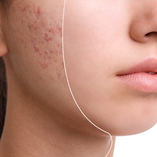 Acne